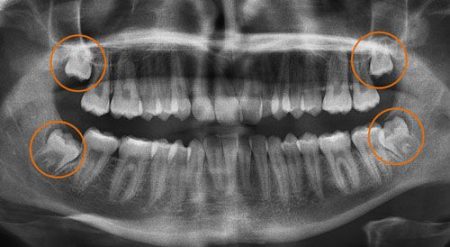 chụp X quang răng