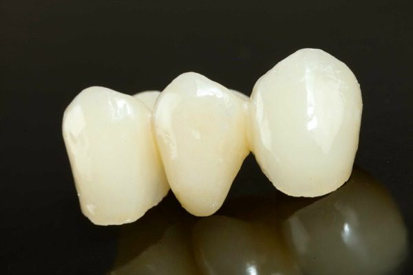 Răng sứ titan có bị đen viền nướu không? Cùng tìm hiểu nguyên nhân chính xác
