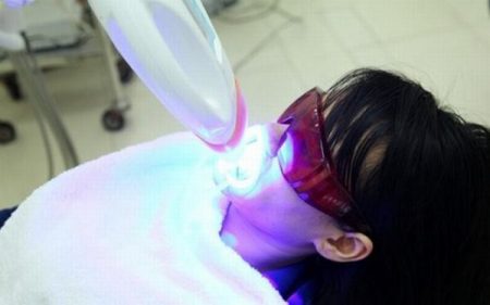 tẩy trắng răng bằng laser whitening