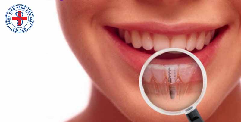 Lợi ích của việc cấy ghép răng implant