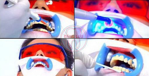 Tẩy trắng răng thẩm mỹ an toàn hiệu quả