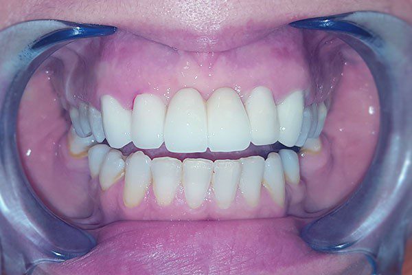 Bọc răng sứ cho răng cửa