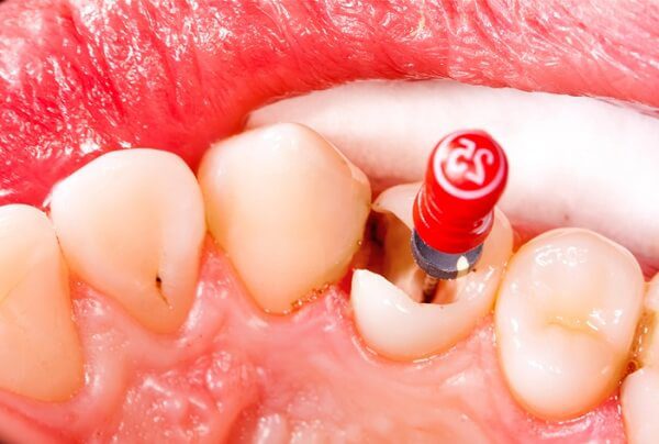 Bọc răng sứ có phải lấy tủy không?