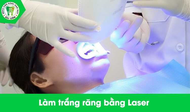 Làm trắng răng bằng Laser