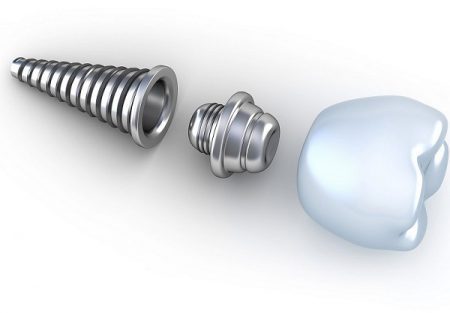 Trồng răng giả ở đâu tốt nhất