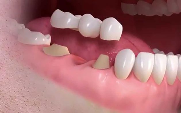 Răng sứ có độ bền cao như răng thật- Trồng răng sứ bao nhiêu tiền?