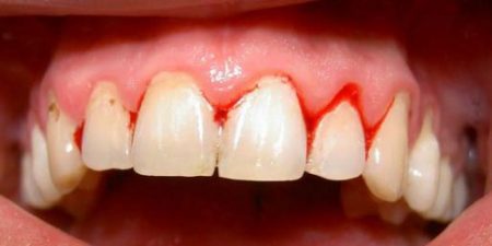 Bệnh viêm chân răng và cách điều trị