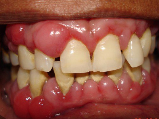 Hình ảnh viêm chân răng có bọc mủ lớn