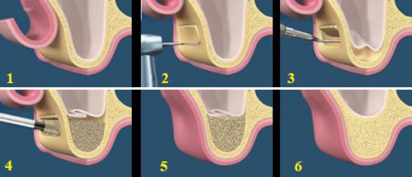 Nâng xoang hàm trong cấy ghép răng Implant