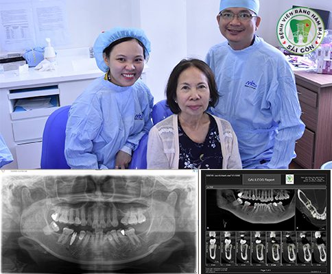 Quy trình cấy ghép răng Implant được thực hiện như thế nào?