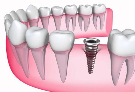 Quá trình cấy ghép implant cho răng cửa