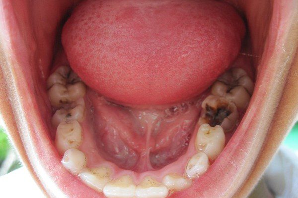 Đau răng khôn nguyên nhân và cách xử lý