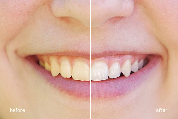 Tẩy trắng răng vĩnh viễn có được không?