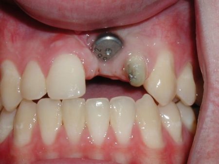 Trồng răng cửa có đau không ? 