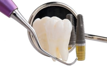 Trồng răng implant có đau và nguy hiểm không?