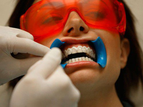 Tẩy trắng răng bằng laser có hại không?