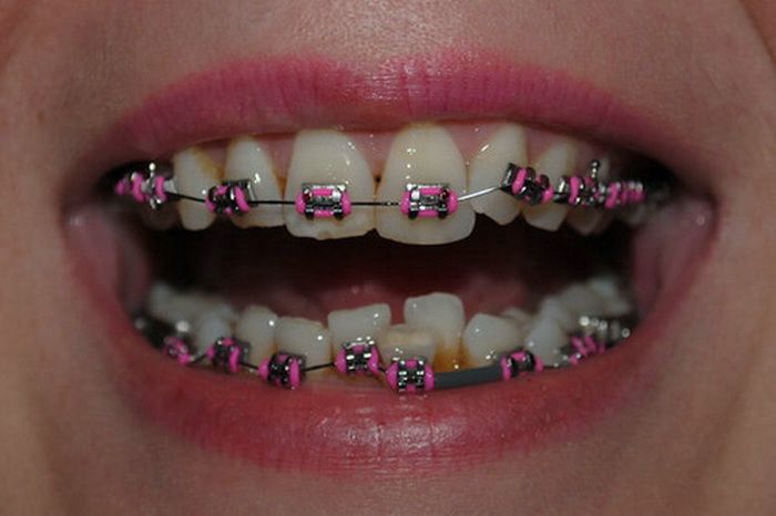 Niềng răng khập khểnh mất bao lâu?