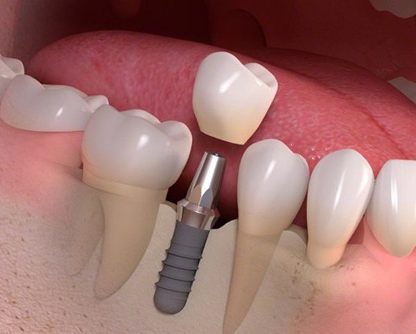 Trồng Implant răng hàm vĩnh viễn