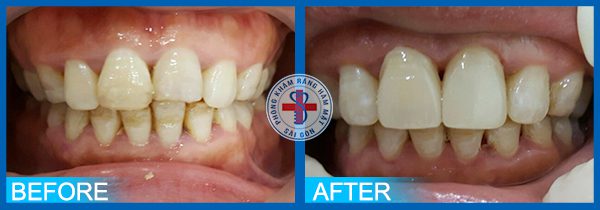 Trước và sau khi bọc răng sứ 5