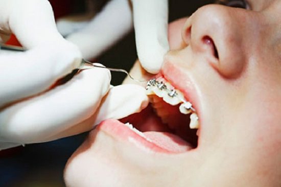 Niềng răng có hại gì không?