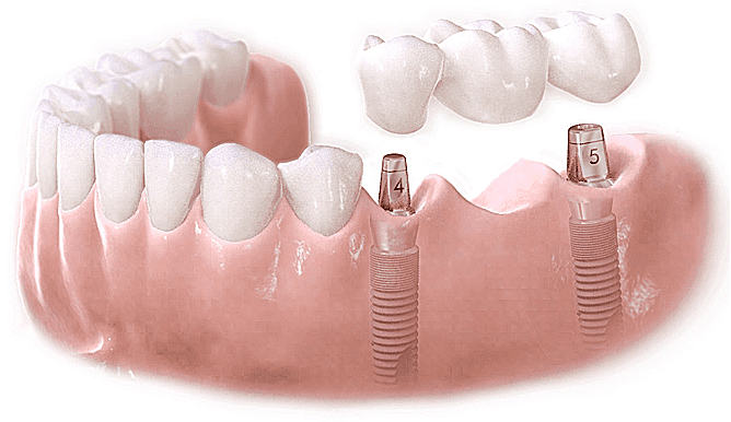 Cấy ghép Implant cho răng hàm như thế nào?