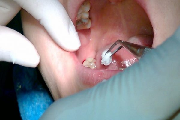 nhổ răng hàm
