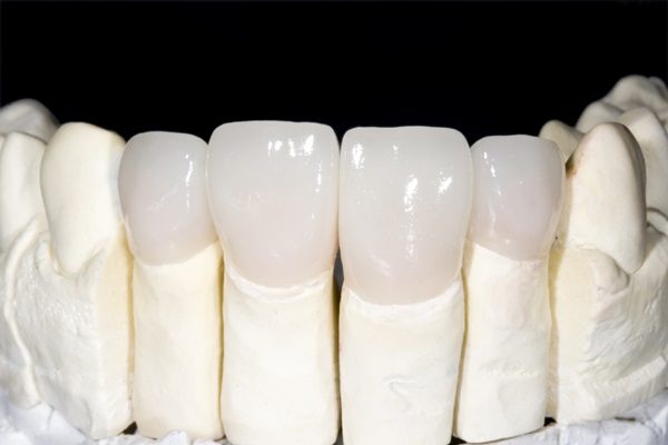 Răng sứ không kim loại có gì đặc biệt?