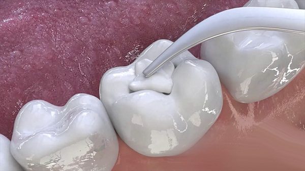  Độ bền của hàn răng sâu phụ thuộc chủ yếu vào vật liệu sử dụng 