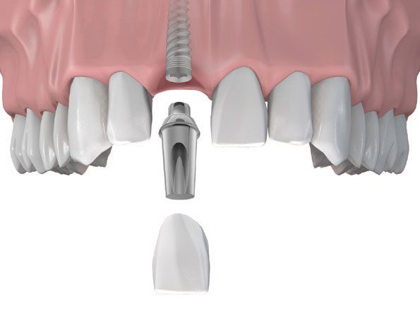 Trồng răng cửa bằng phương pháp cắm Implant