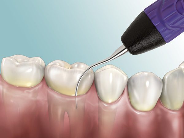 Lấy vôi răng có ảnh hưởng gì không?