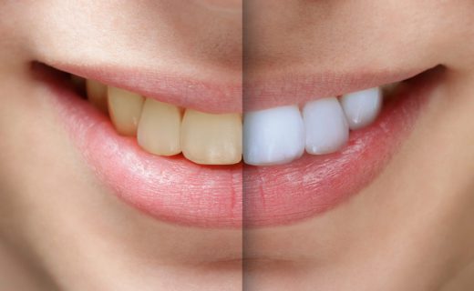 Tẩy trắng răng có đắt không?