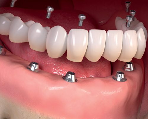 Trồng răng giả Implant 