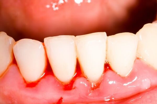 chảy máu chân răng là bệnh lý gì