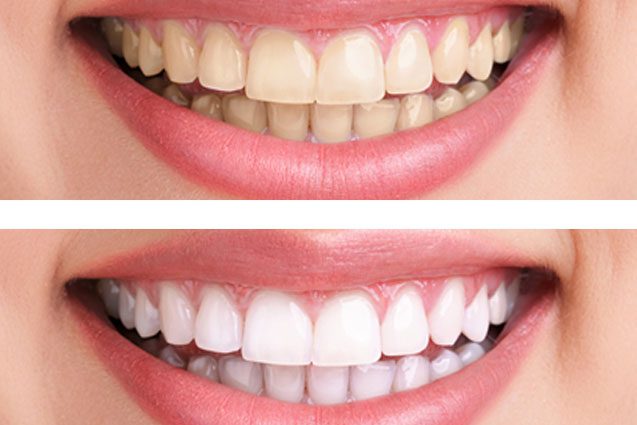 Những cách tẩy trắng răng tại nha khoa
