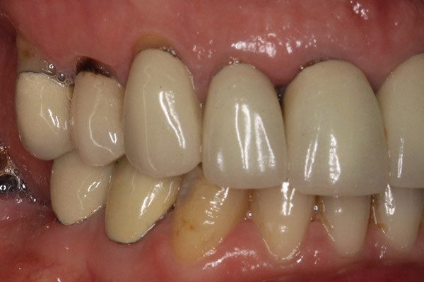 Răng sứ kim loại thường có tốt không?