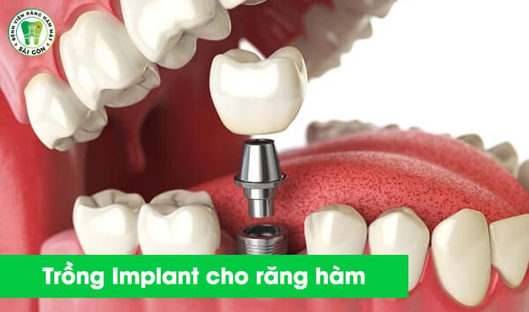 trồng Implant cho răng hàm