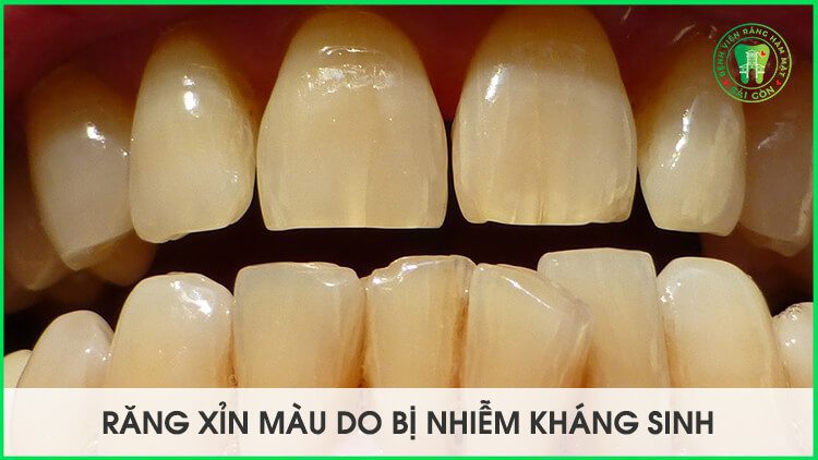 tẩy trắng răng bị nhiễm kháng sinh