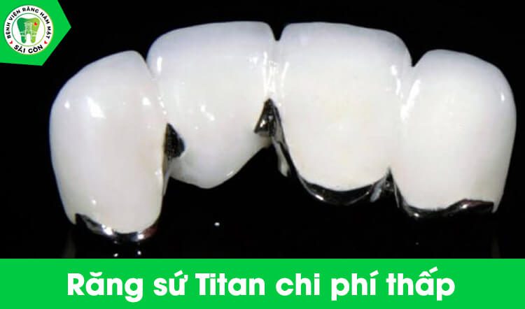 răng sứ Titan giá bao nhiêu