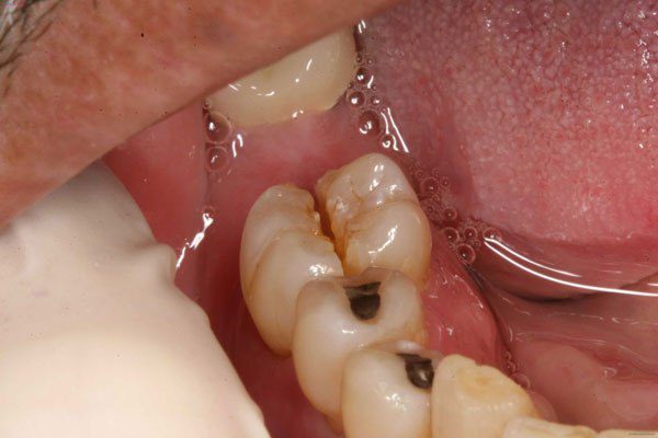 Nhổ răng hàm có nguy hiểm không? 
