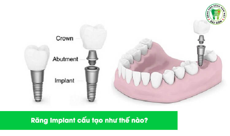 Làm răng implant là gì