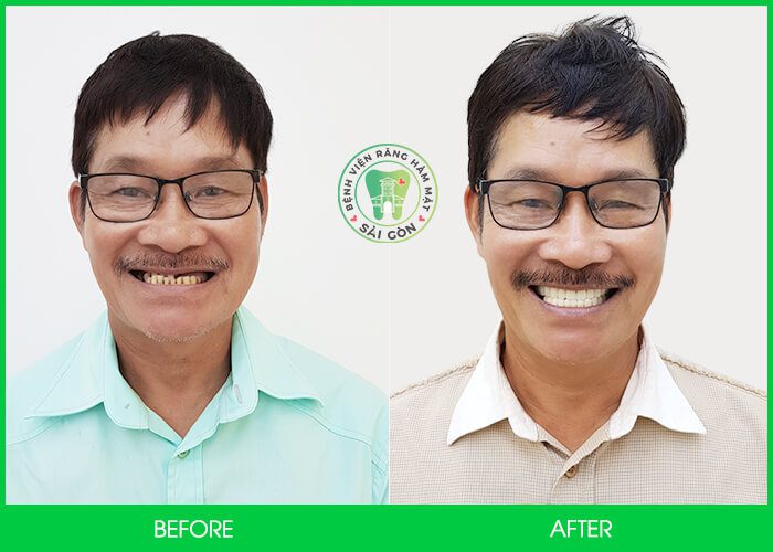 khách hàng bọc sứ