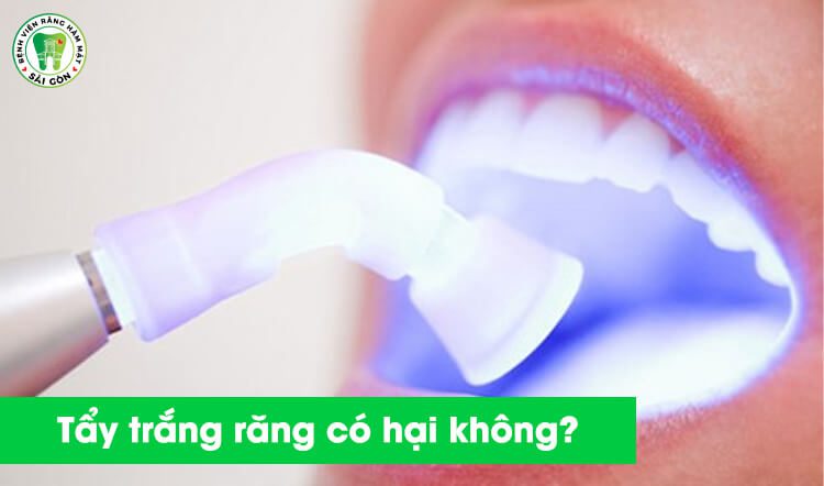 Tẩy trắng răng có hại hay không