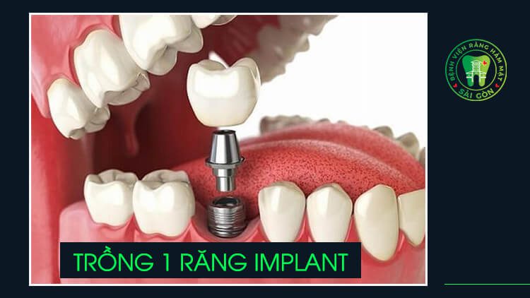 trồng 1 răng Implant