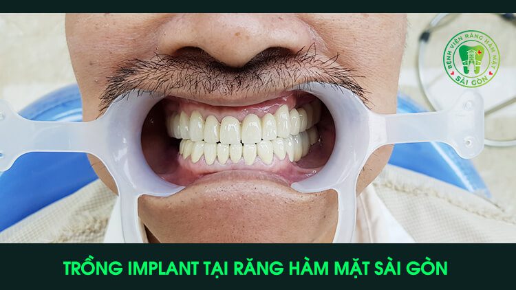 Trồng răng Implant 