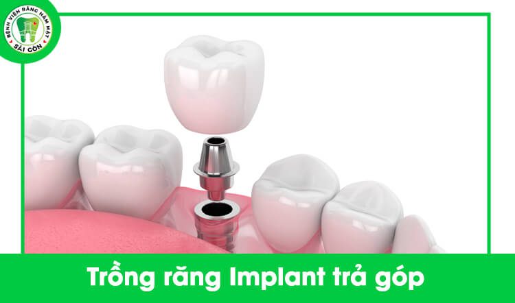 trồng răng Implant trả góp