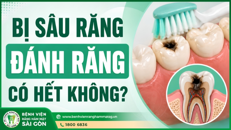 Bị sâu răng đánh răng có hết không? Cách điều trị sâu răng